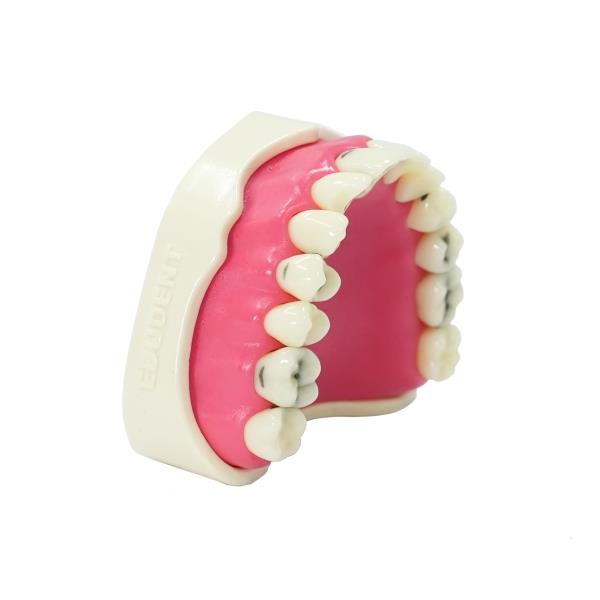Edudent RestoPrep® Çürüklü Tek Çene Diş Modeli - Endodontik Eğitim Seti