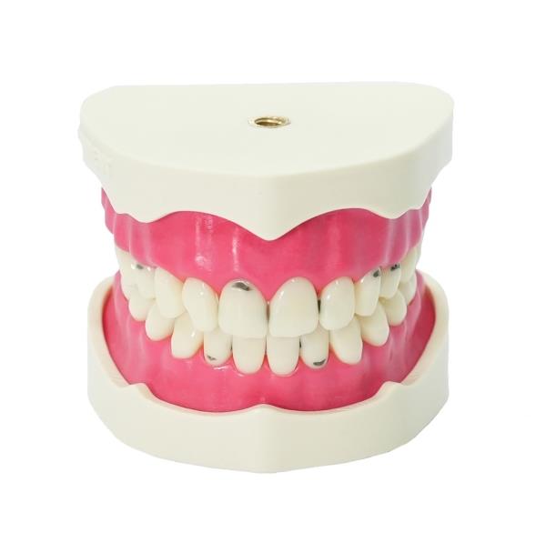 Edudent RestoPrep® Çürüklü Alt ve Üst Çene Diş Modeli - 28'li Set